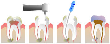 pictures tooth crown
