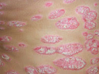 What is psoriasis?