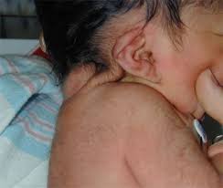 with Turners syndrome.