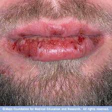 Stevens-Johnson Syndrome