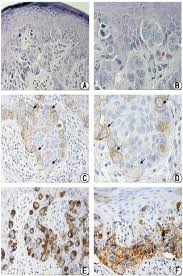 adenopatia inguinal