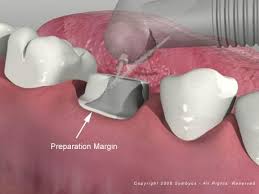 pictures tooth crown
