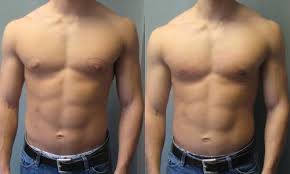 gynecomastia
