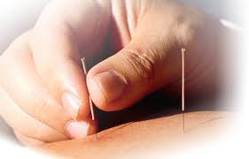Acupuncture Service