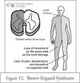 <b>Brown</b>-<b>Séquard syndrome</b> occurs