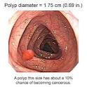 Colon Polyp Picture - Picture of Colon Polyp 1.75 cm
