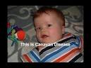 Canavan Disease – FREE Canavan Disease information | Encyclopedia ...