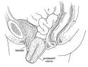 Treating Uterine Prolapse without Surgery - Amy E. Rosenman M.D.