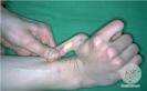 DermIS - Ehlers-Danlos Syndrome (