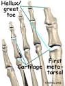 <b>Hallux</b> rigidus | eorthopod.com