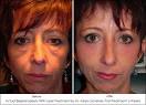 Laser By Dr. Adam Scheiner