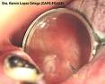 <b>neoplasias</b> malignas.