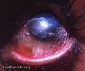 Vitamin A deficiency: florid <b>xerophthalmia</b>. EyeRounds.org: Online