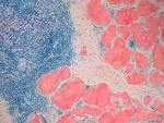 File:Amyloidosis, Node, Congo Red.jpg - Wikipedia, the free ...