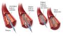 Angioplasty and Stent Implantation