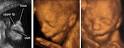 Ultrasound Obstet Gynecol 2000