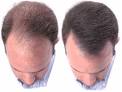 DermMatch hair loss concealer - Hair loss treatment