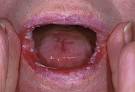 How To Treat Thrush