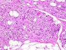 return to <b>Angiolipoma</b>