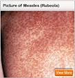 MEASLES (Rubeola): Get Facts About Symptoms and Treatment