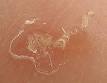 Nodular lesions from <b>scabies</b>