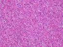 <b>Adrenal</b> gland and paraganglia - <b>Adrenocortical adenoma</b> - general
