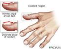 Clubbed fingers