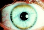 disease (<b>hepatolenticular</b>