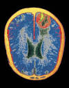 <b>Encefalite</b>