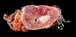File:Adrenal paraganglioma clinical <b>Pheochromocytoma</b>.jpg