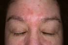 Seborrheic Dermatitis Picture (Hardin MD Super Site Sample)