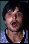 <b>Sindrome di Stevens</b>-<b>Johnson</b>.