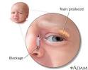 Blocked <b>tear duct</b>