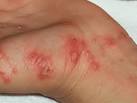 <b>Scabies</b>