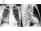 <b>pneumopathie</b>-bilaterale-