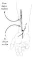 <b>fistula</b> or <b>A-V fistula</b>