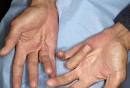 of <b>Dupuytren's Contracture</b>