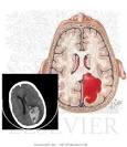 <b>Intracranial Hemorrhage</b> in a