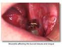 <b>Mucositis</b> and oral infection