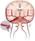 hemorrhage pronunciation