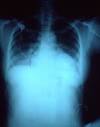 Congestive Heart Failure Overview