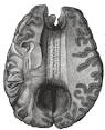 Corpus callosum - Wikipedia, the free encyclopedia