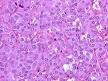 230px-<b>Pheochromocytoma</b>_high_ ...