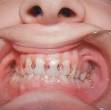caries - definition of caries in the Medical dictionary - by the ...
