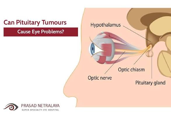 Can Pituitary Tumours Cause Eye Problems?