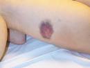 chaud, sur la <b>contusion</b>