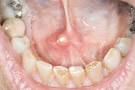 <b>Salivary gland</b> tumors &
