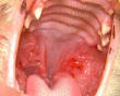 <b>stomatitis</b>