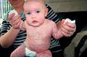 This is little Stephanie Brown who has a rare skin disease which covers her ... - stephanie-brown-pic-caters-888258478