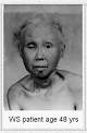 of Werner's Syndrome.